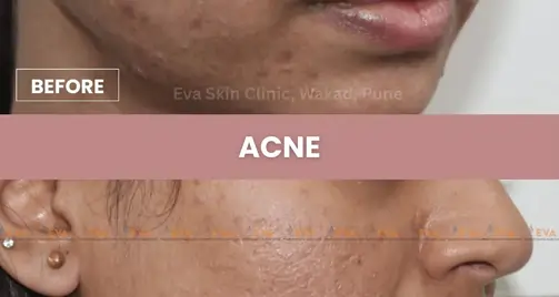 Achne Treatment Services In Uttam Nagar